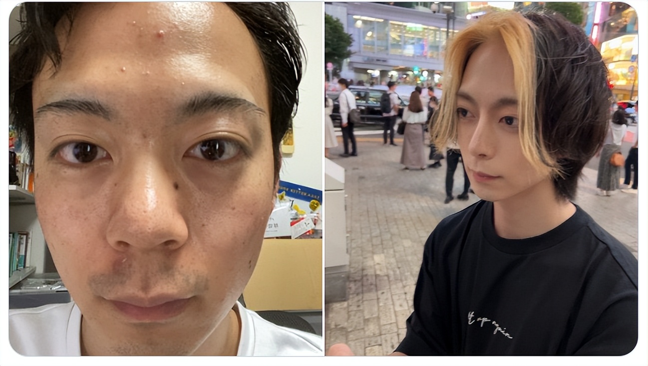 日本1米5小哥砸1600万疯狂整容增高！断骨惨烈过程吓傻网友