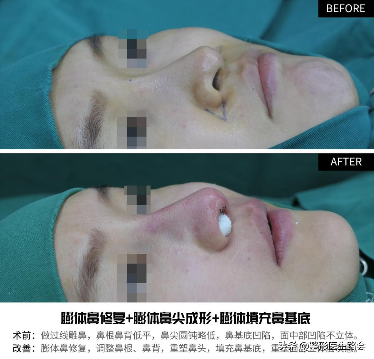 隆鼻三年后可以蹦极嘛,做了隆鼻到底可以蹦极吗