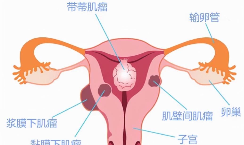 中医治好了16厘米的子宫肌瘤,子宫肌瘤10厘米中药偏方
