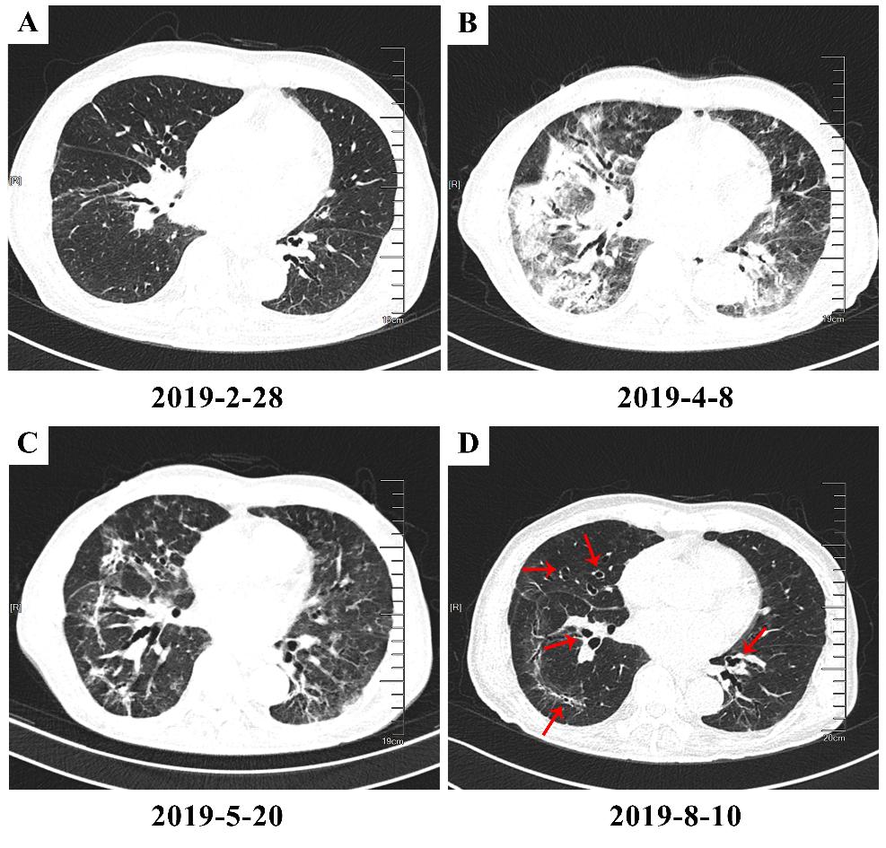 周承志湖北中医医院,周承志免疫治疗