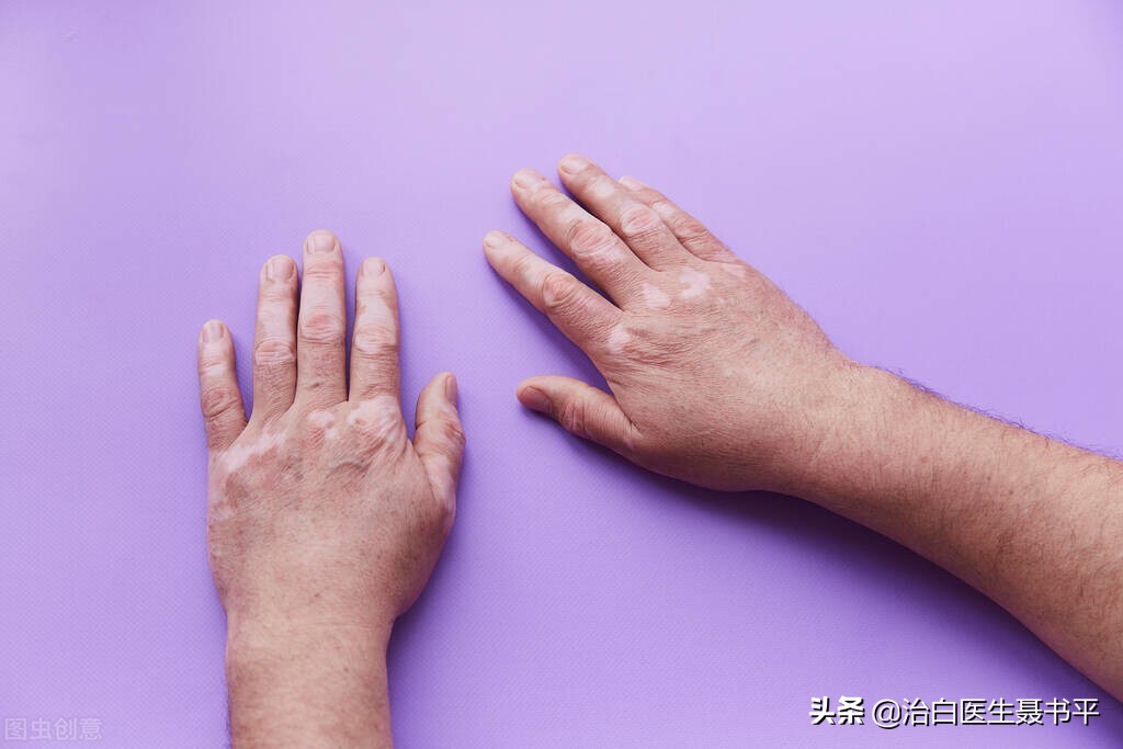 刚出现的白癜风照308激光治疗，一般多久能有效果？