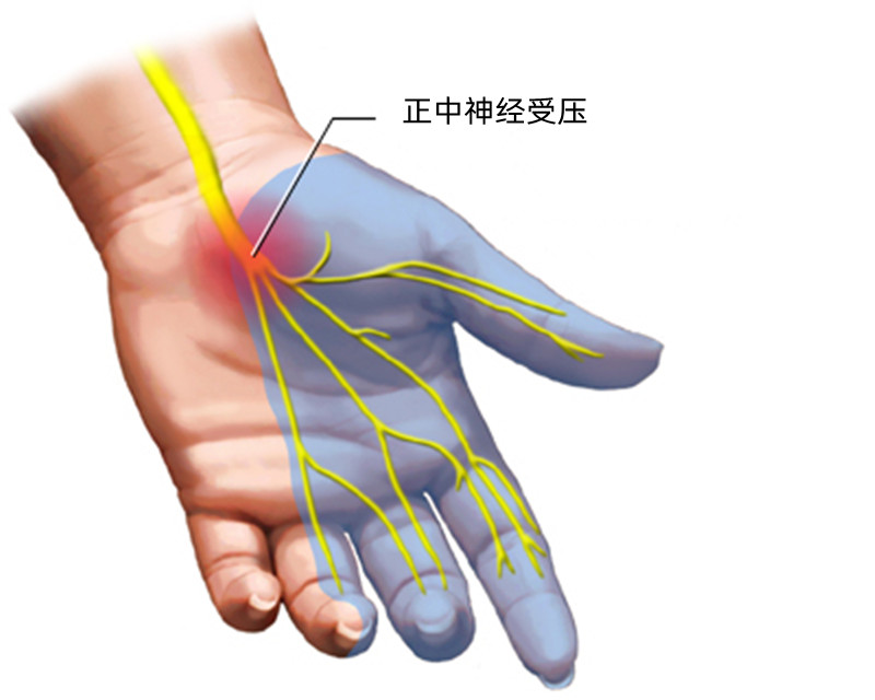 手指麻木是风湿引起的吗,手指麻木是颈椎病还是腕管综合征