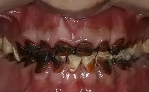 什么样的可乐牙需要治疗,健康科普温馨提示信息