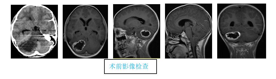 7岁脑瘤患儿转运至广州救治直播,治愈后的脑肿瘤儿童