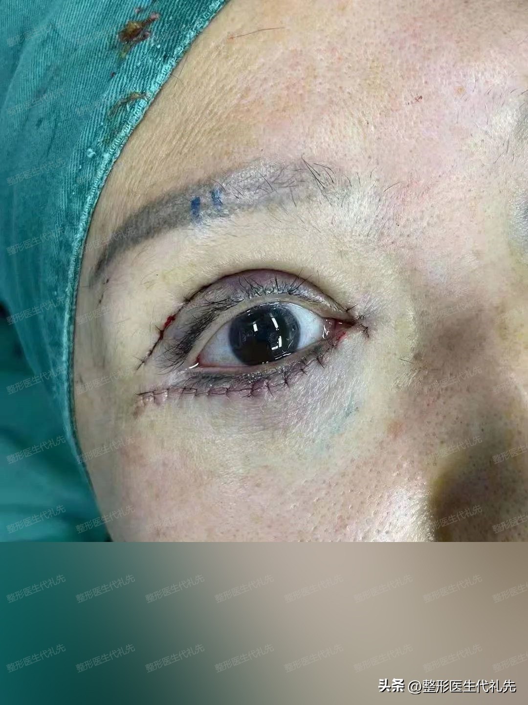 55岁女士做双眼皮能转运吗,北京双眼皮眼袋手术