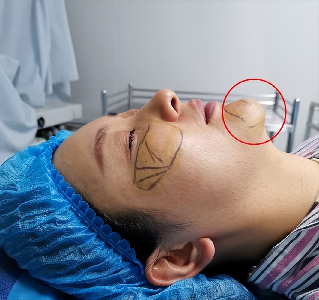 注射骨粉有什么后果,注射骨粉失败案例