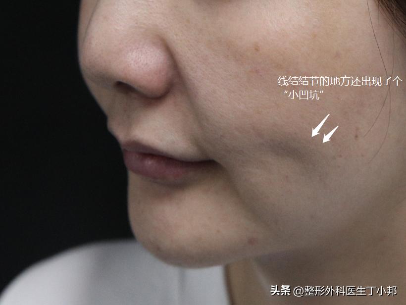 法令纹填充移位案例,法令纹爆炸线几天恢复