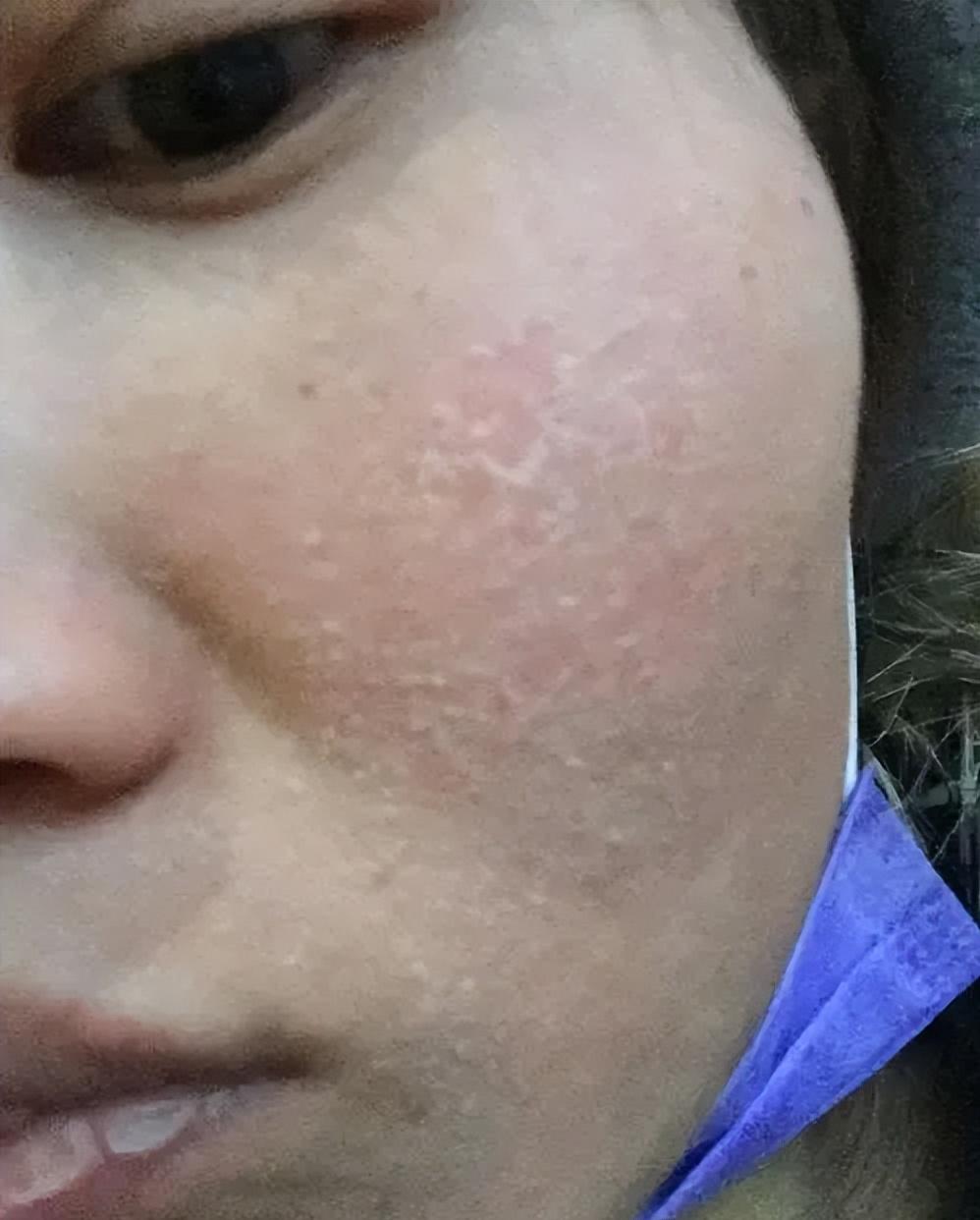 脸泛红是洗面奶的原因吗,为什么用完洗面奶脸会变白