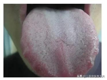 啤酒肚，大肚腩，痰湿壅盛？二陈汤，燥湿化痰，利湿，消除大肚腩