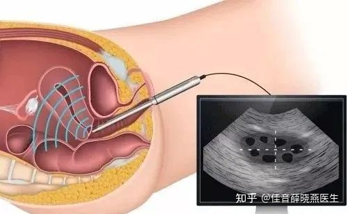 冻胚移植前孕酮和内膜多少正常,移植冻胚月经第十天内膜1.0
