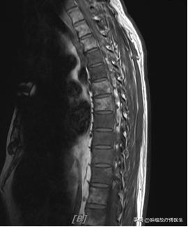 前列腺癌psa8,前列腺癌内分泌治疗psa降低至2.75