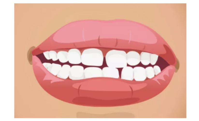 牙缝大牙齿怎么补,牙齿稀疏牙缝大有什么危害吗