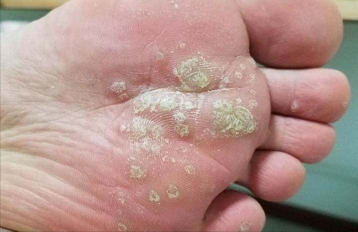 手足疣痊愈过程,跖疣治疗经验分享