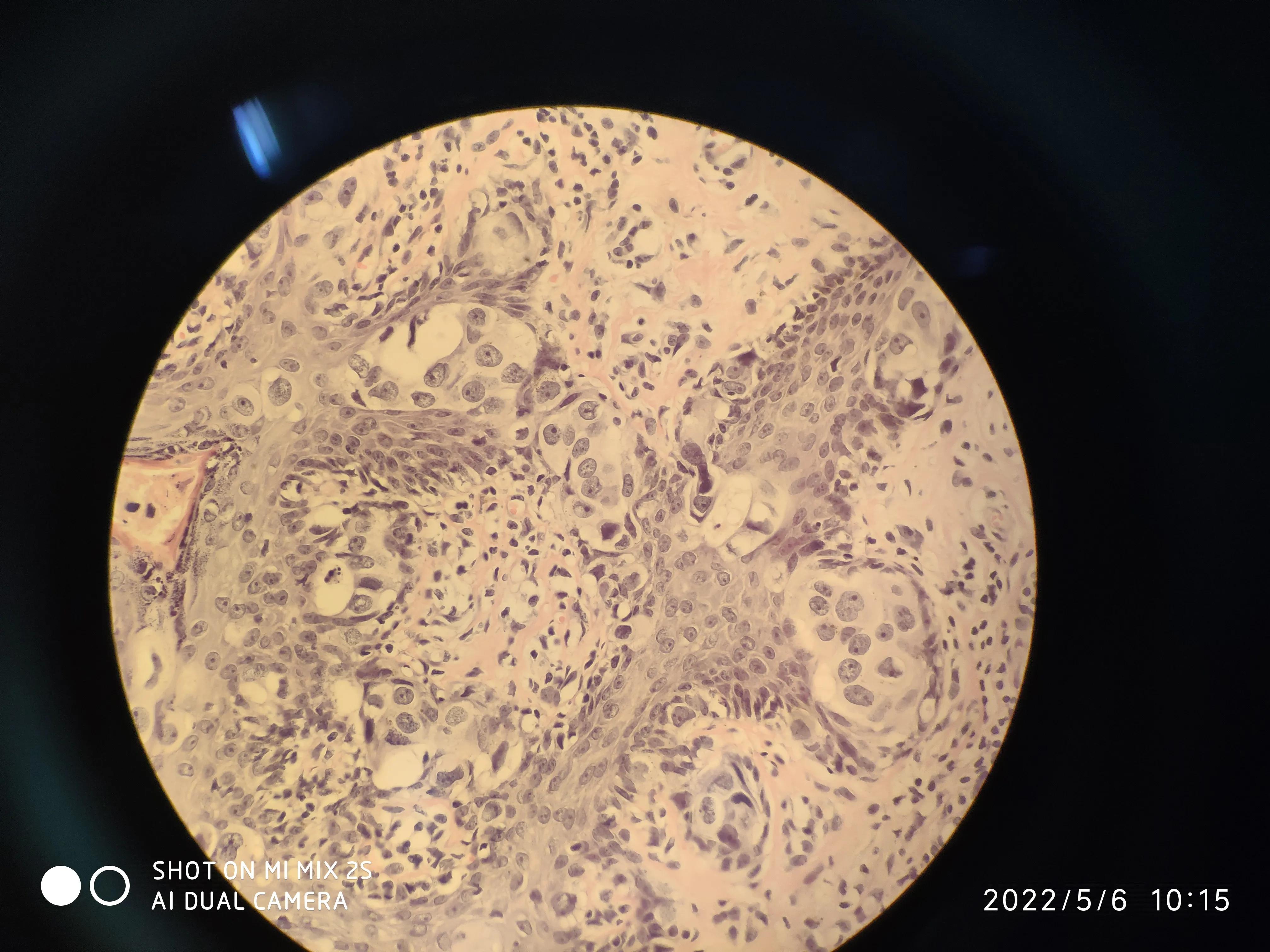 乳头湿疹样病变,乳头样湿疹