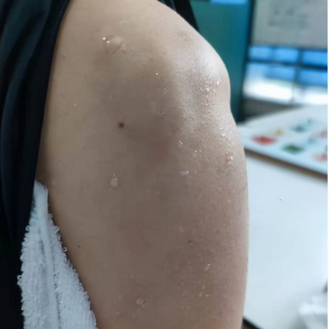 脑梗偏瘫后注意事项,脑梗偏瘫肢体恢复期最初锻炼方法