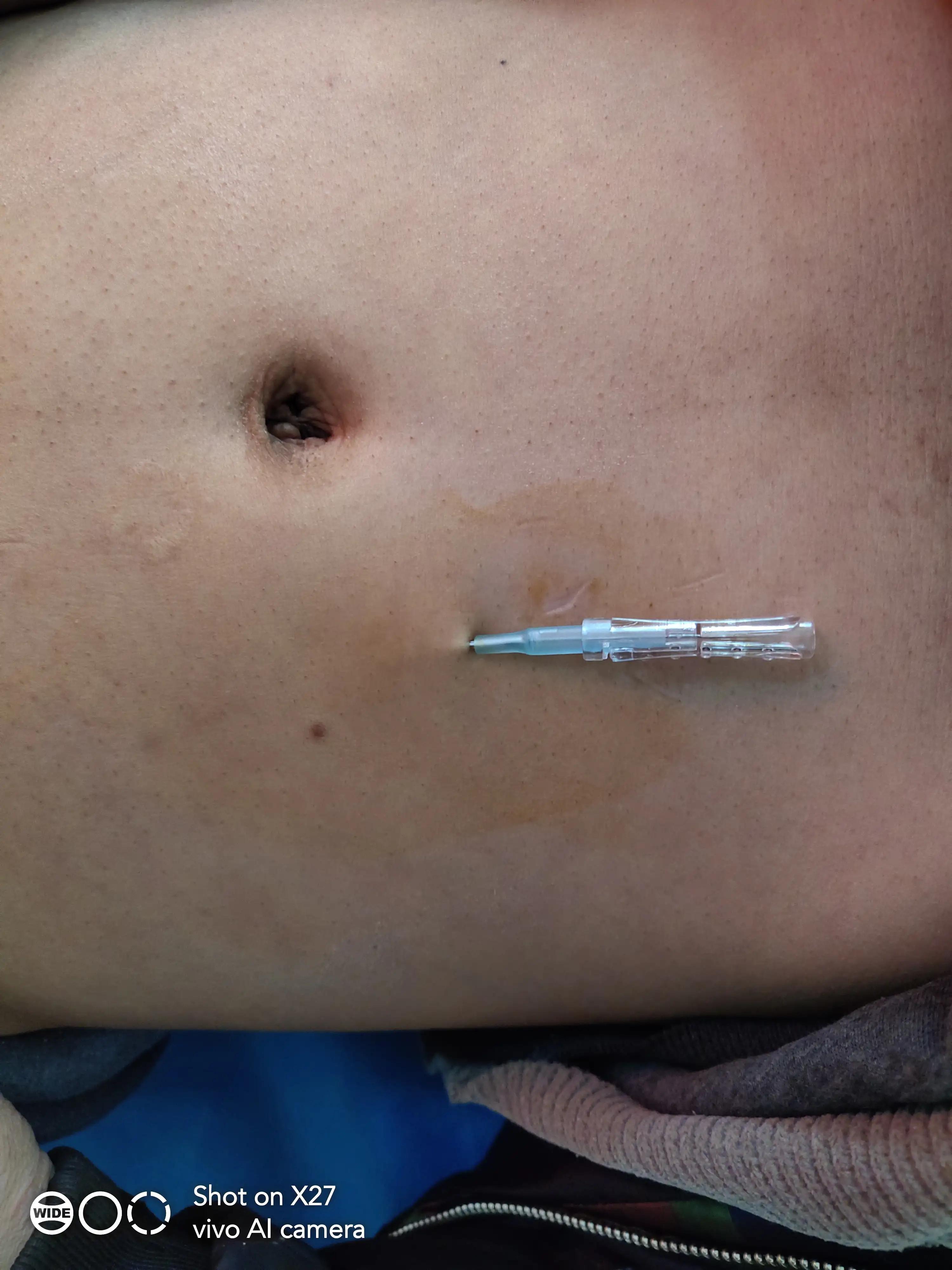 腹痛浮针,浮针治腹痛案例