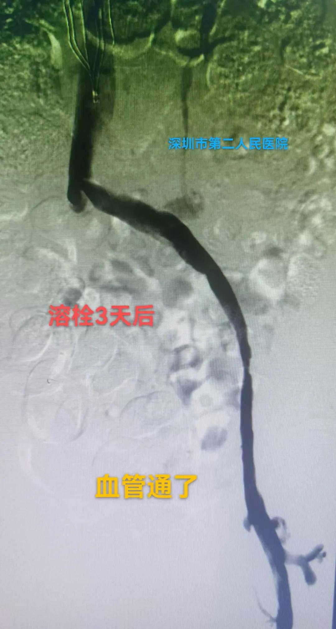 一到下午就腿肿什么原因怎么治疗,腿肿是什么病的前兆怎么治疗