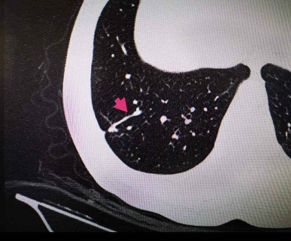 肺结节怎么解决,呼吸科与胸外科看肺结节哪个准