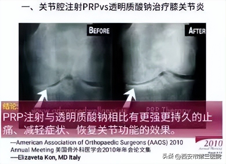 prp治疗膝关节弯曲角度效果,prp治疗膝关节有发热症状