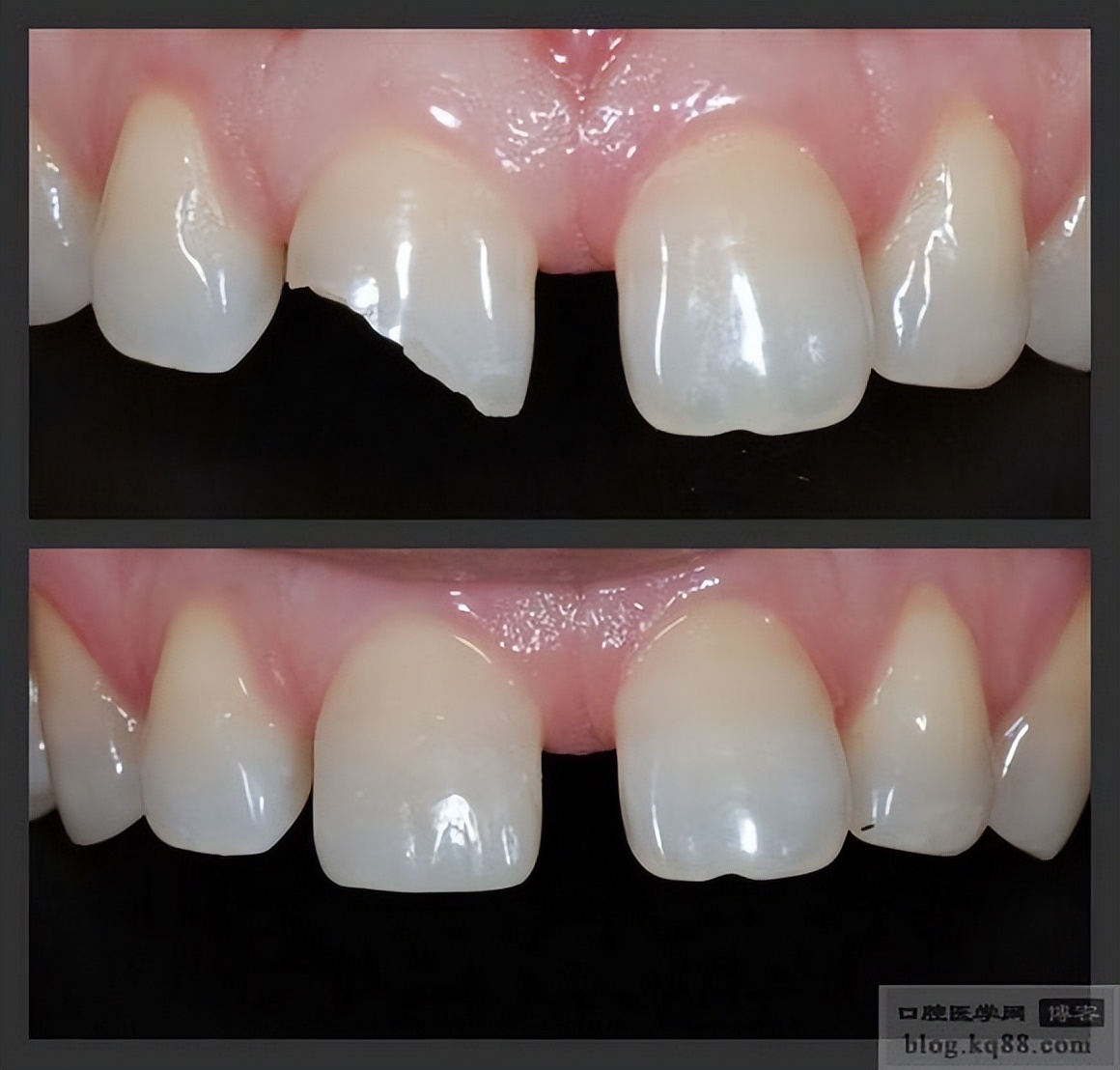 牙齿断了一半怎么处理最好多少钱,牙齿断了一半怕冰怎么处理最好