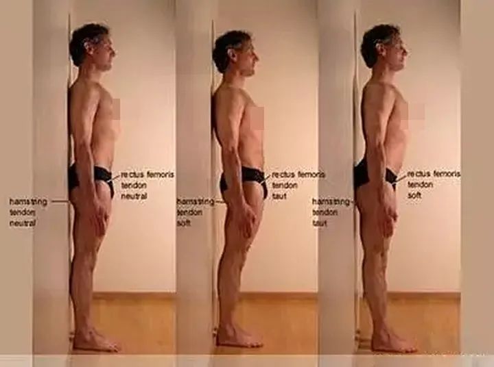 屁股太翘是什么病,屁股翘的病