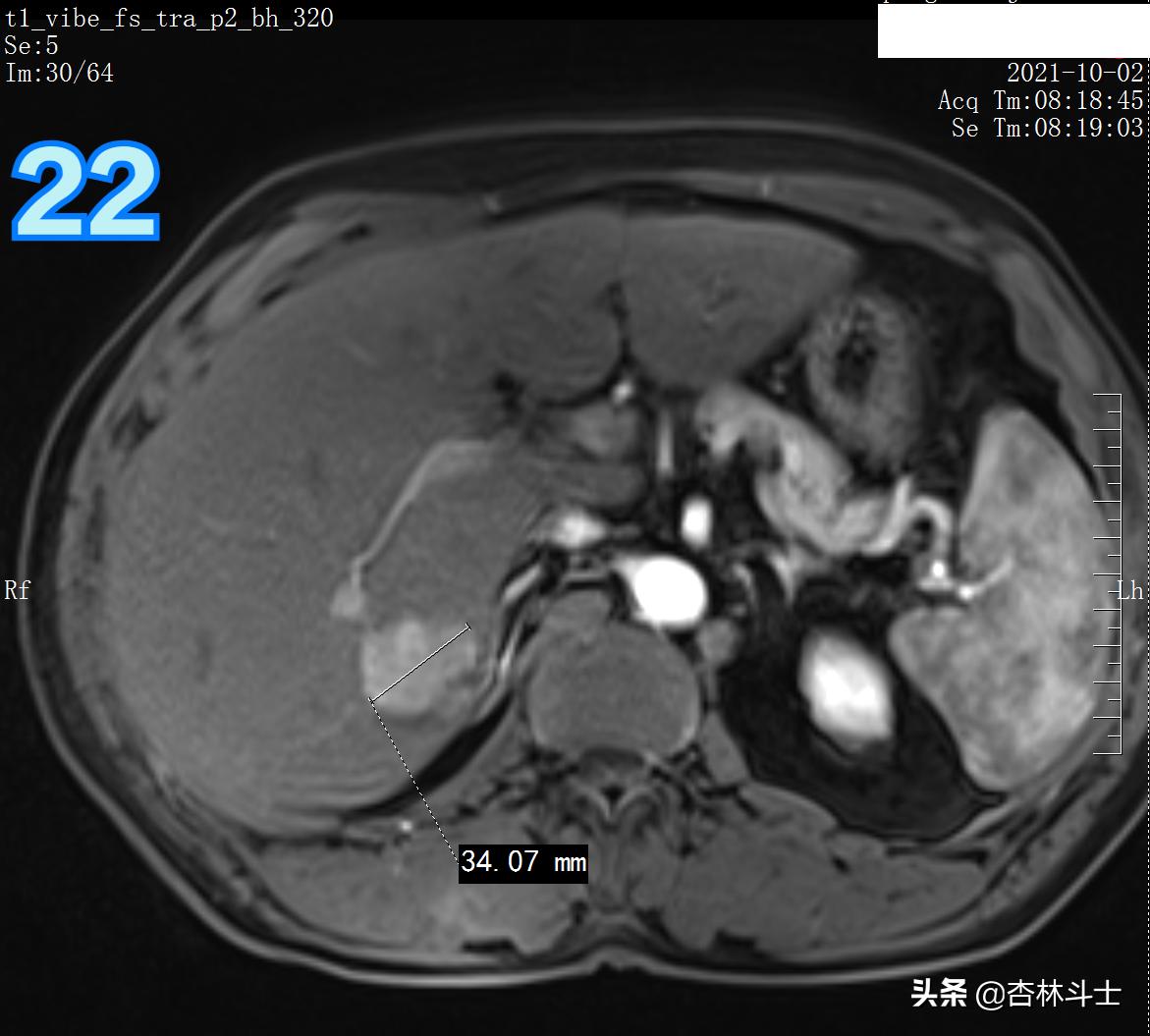 肝癌8公分肿瘤能活多久,肝癌细胞最大长多大