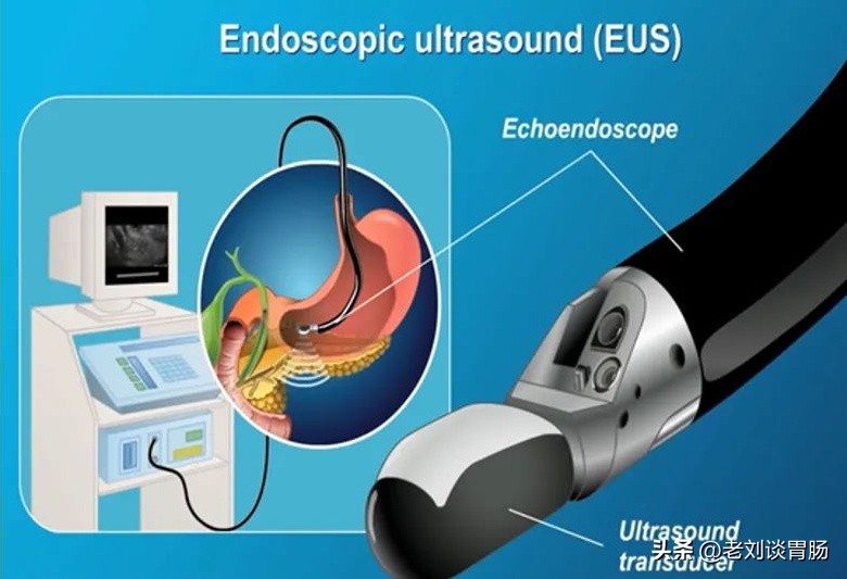 什么是异位灶怎么治疗,异位胰腺是怎么引起的