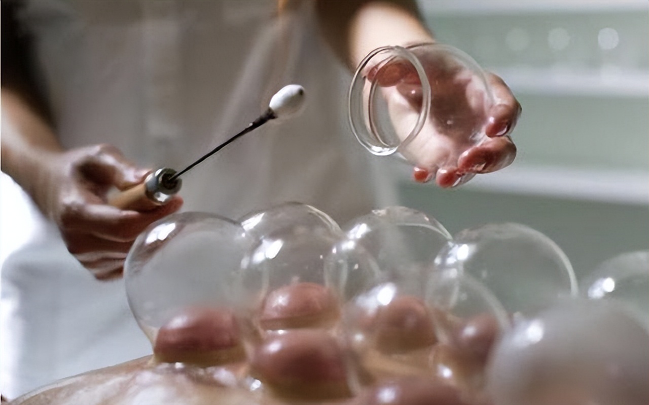 拔火罐吸出来的是湿气还是毒素,拔火罐时吸出的淤血是毒素吗