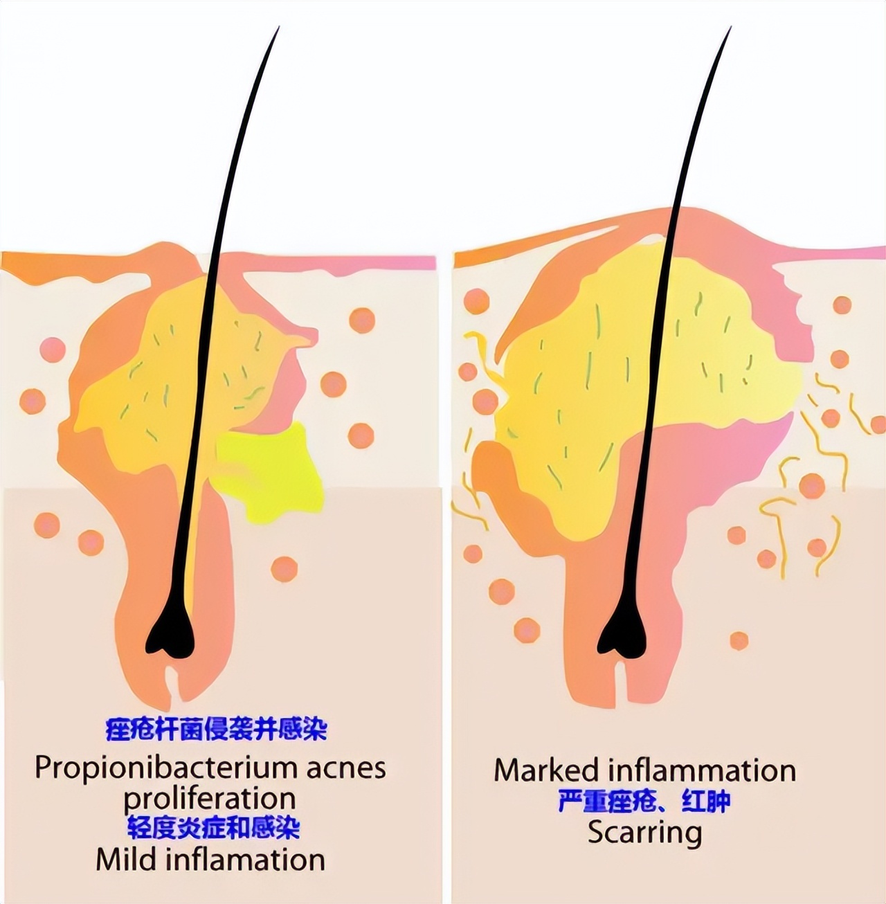 关于非青春期痘痘的一些战痘经验,治疗反复起痘最有效的东西