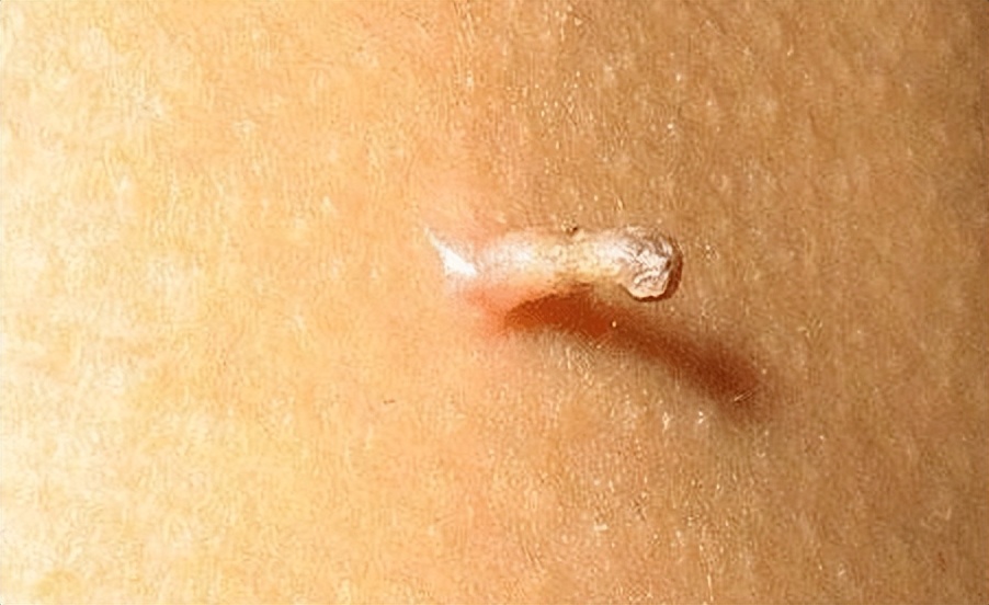 谈谈扁平疣的治疗,关于扁平疣内容