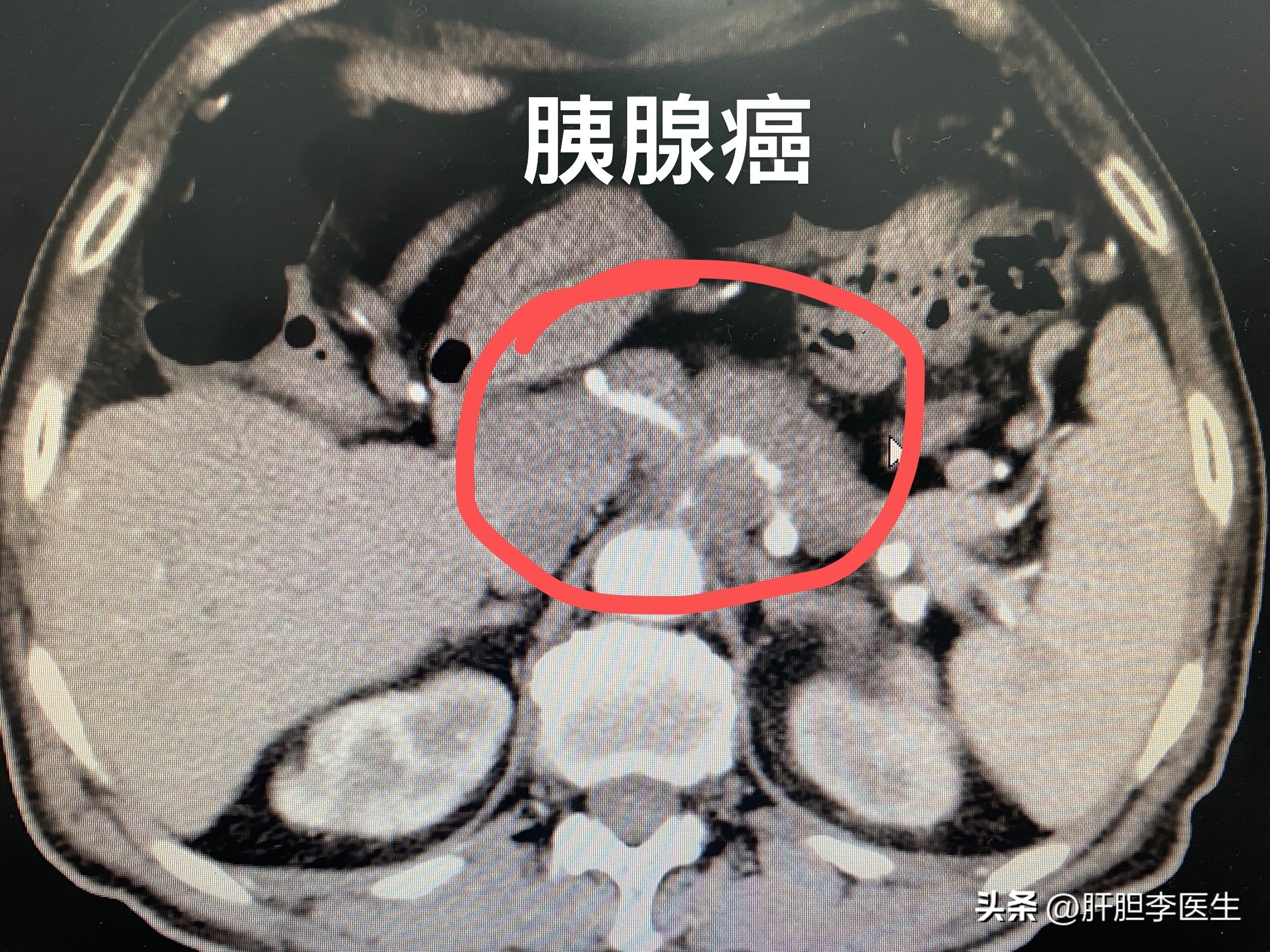 胃疼半年了后背也疼怎么回事,胃疼了半个月了吃了药也不好
