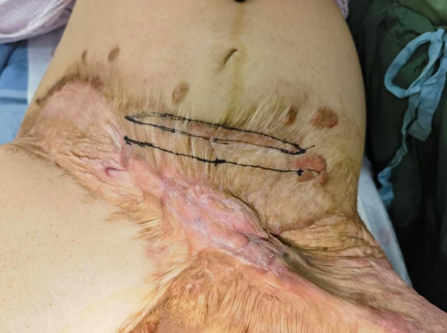 被车碾压的女孩救活了么,被大货车碾过的人