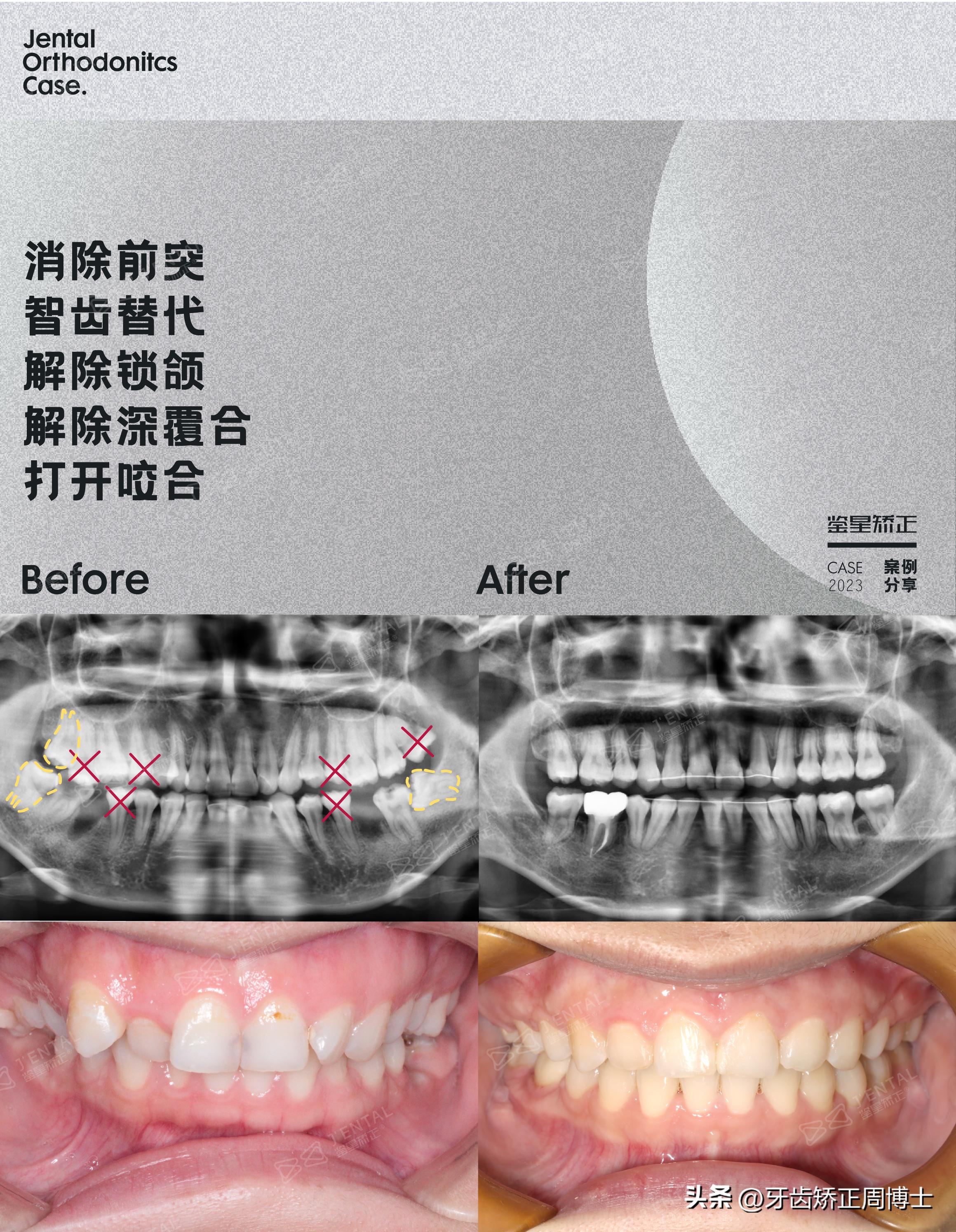 轻度拥挤龅牙咬合错位,龅牙导致牙齿咬合错位矫正价格