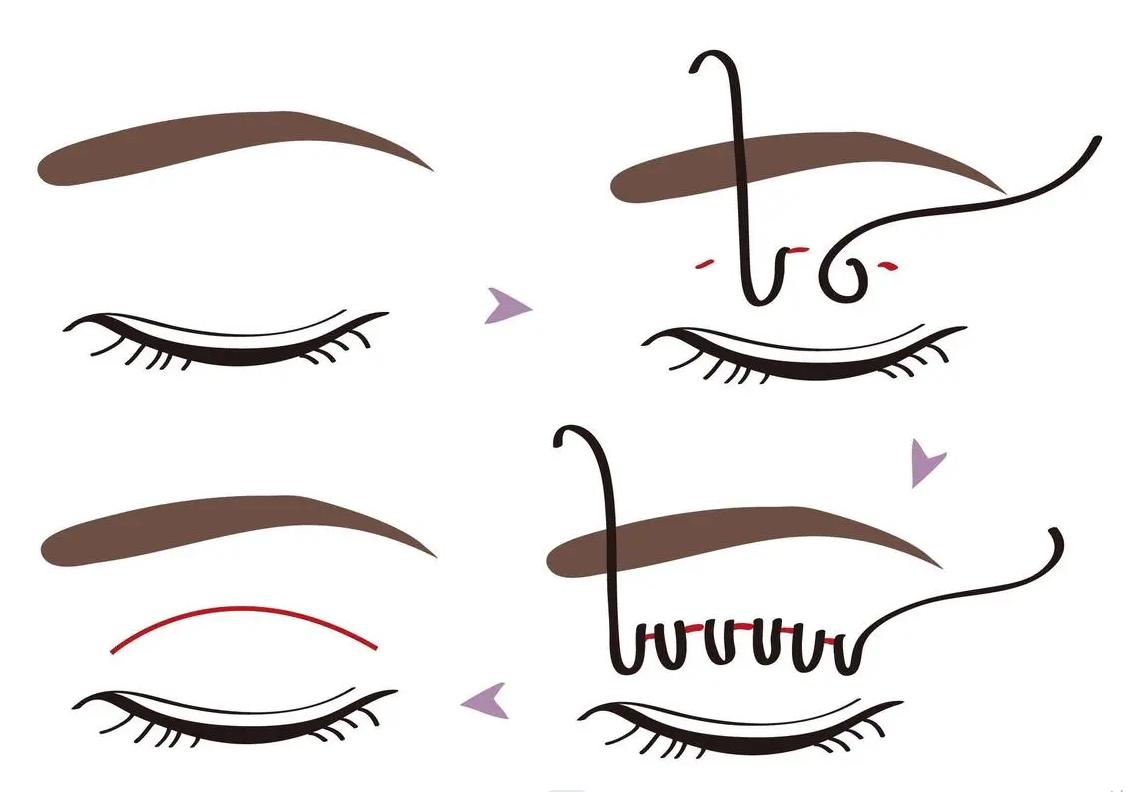 广州做双眼皮好的三甲医院和医生,西京医院双眼皮哪个医生做得好