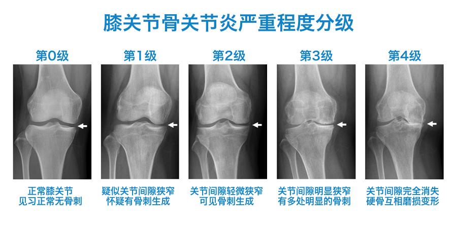 膝盖髌骨软骨疼痛部位对照表,膝盖下方胫骨疼痛部位对照表