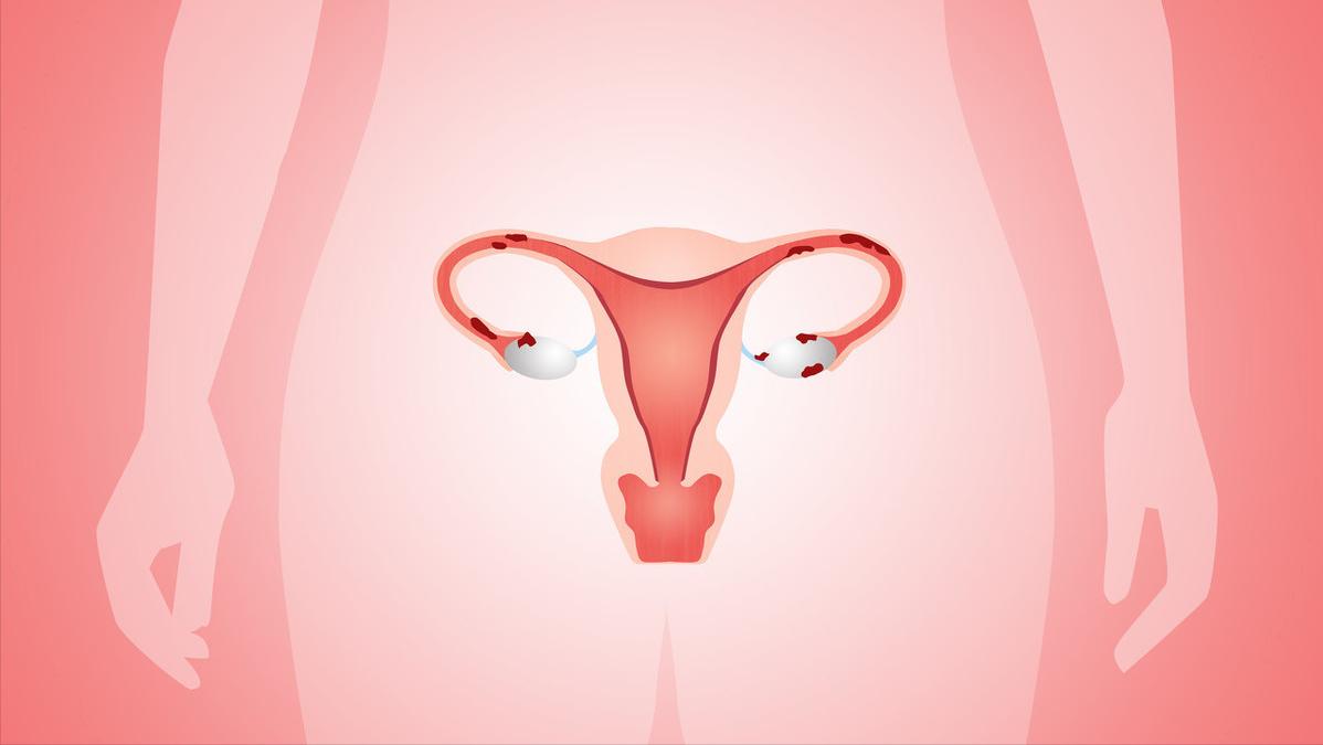 54岁女子确诊外阴癌，追悔莫及！提醒女性：下身4种异常，别大意