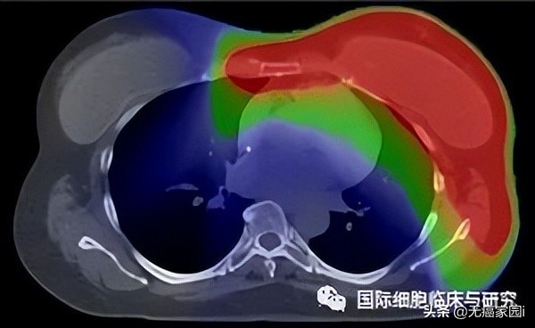 脑瘤、肺癌及儿童肿瘤等不妨考虑质子治疗,疗效和生存质量双保障