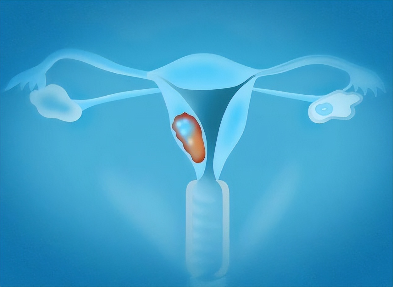 外阴癌有什么先兆,外阴癌会有怎样的症状