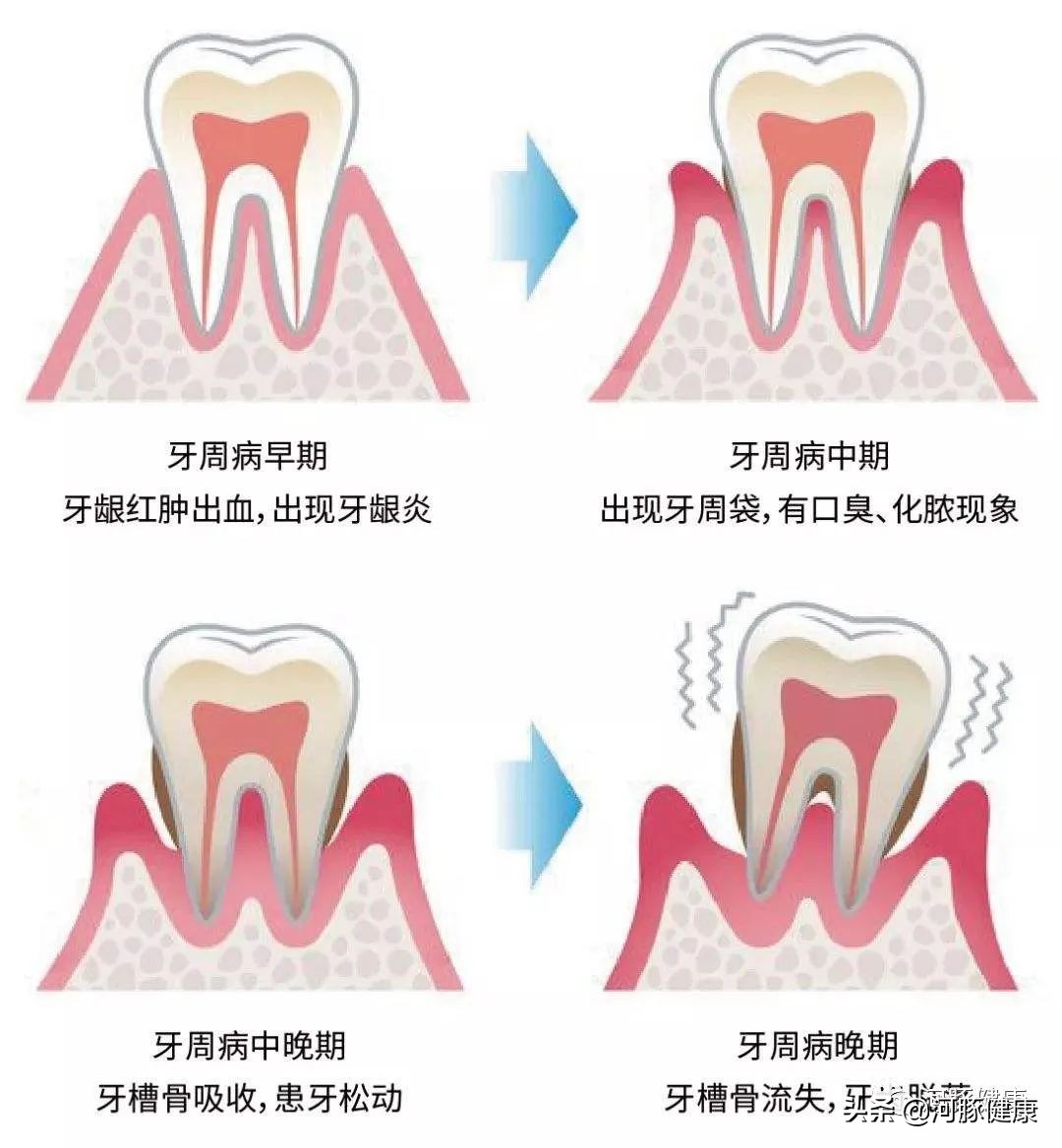 刷牙时牙龈出血要警惕,刷牙时牙龈出血牙膏会进入血液吗
