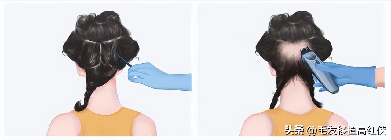剃发植发和不剃发植发有什么区别,不剃发植发与剃发植发的区别