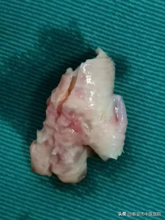 *安泰**市中医医院脑病外科成功开展一例高难度“颈动脉内膜剥脱术”