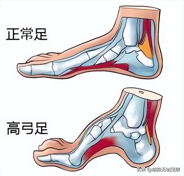 哪里能治小儿足内翻,小儿足内翻治疗最佳方法