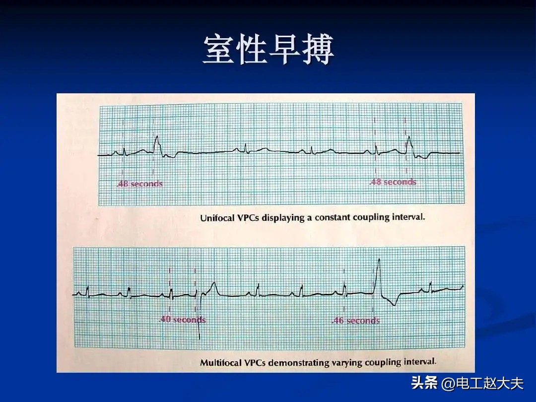室性早搏有没有比较好的治疗方法,室性早搏射频消融治疗的方法