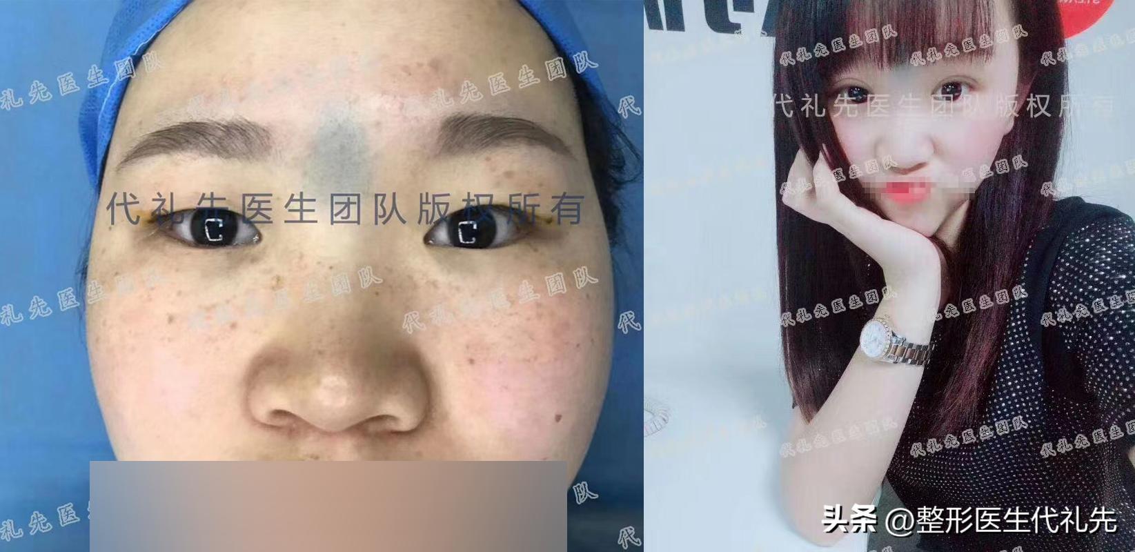 眼球鼓做全切双眼皮,全切双眼皮缝合位置有凸起小疙瘩