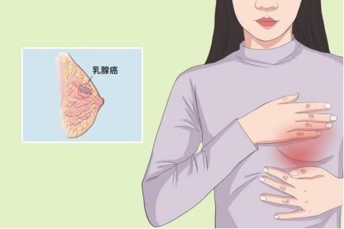 所有乳腺癌患者都需要打“肚皮针”吗？