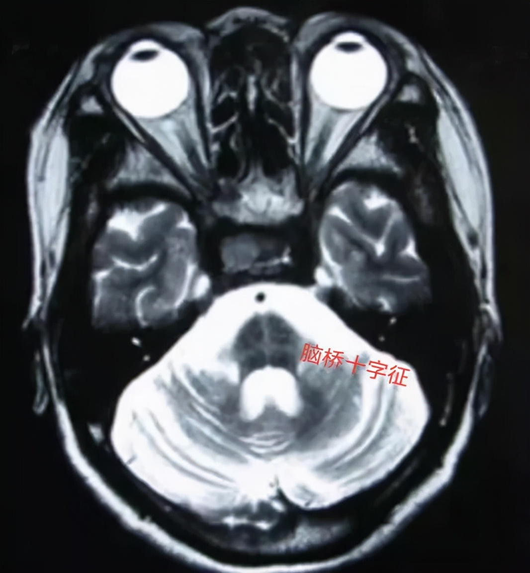【小帕讲故事】诊断多系统萎缩1、2、3