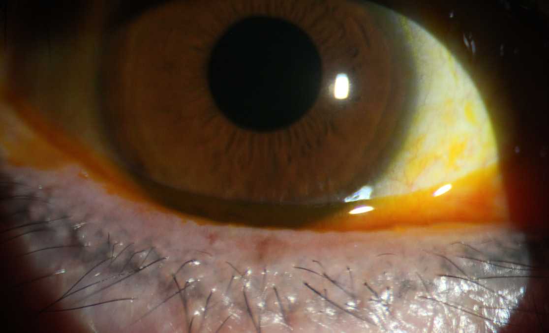 眼睛总是流泪是肝的问题吗,眼睛总是流泪是红眼病吗