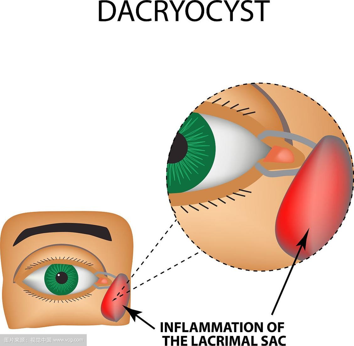 泪囊吻合手术和置管有啥区别,泪囊切除术是几类切口