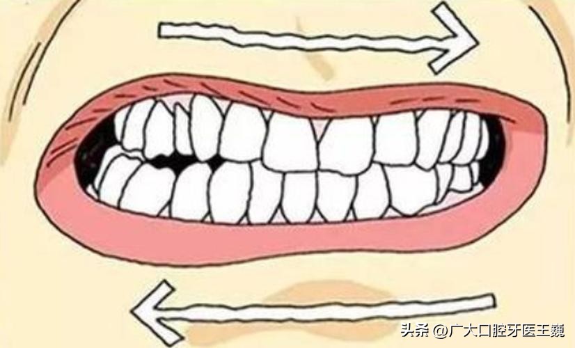 正畸的托槽总是掉怎么办,正畸完发现牙根有坑