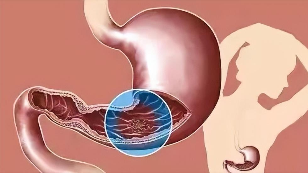 “甲硝唑”便宜又好用，能治什么病？这3种病可适用